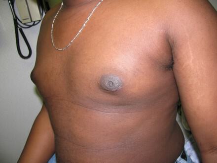 Gynecomastia Surgery Before & After Image