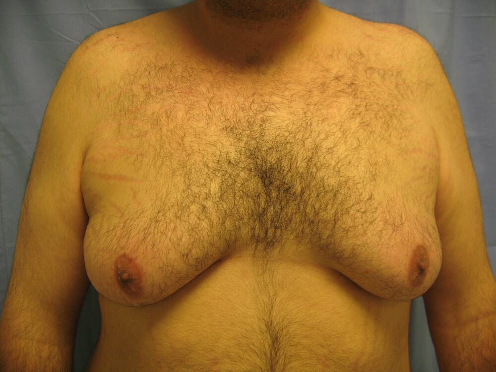 Gynecomastia Before & After Image