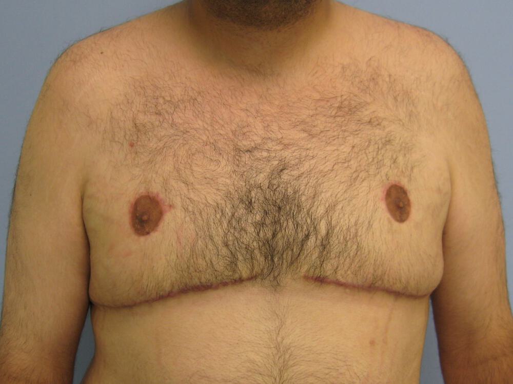 Gynecomastia Before & After Image