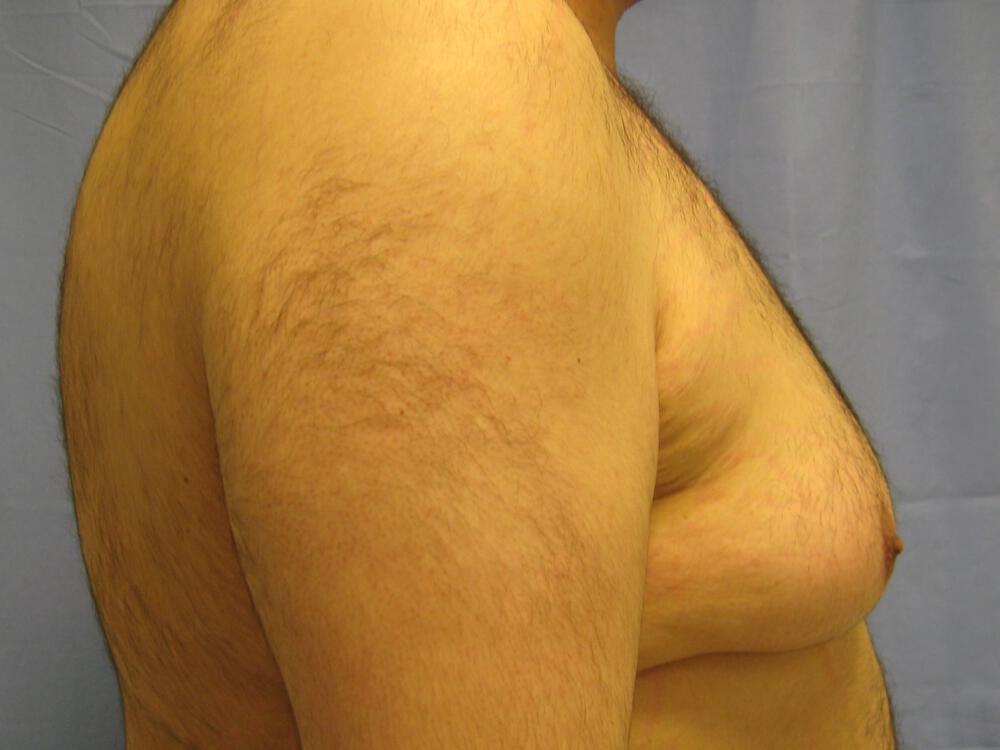 Gynecomastia Before & After Image