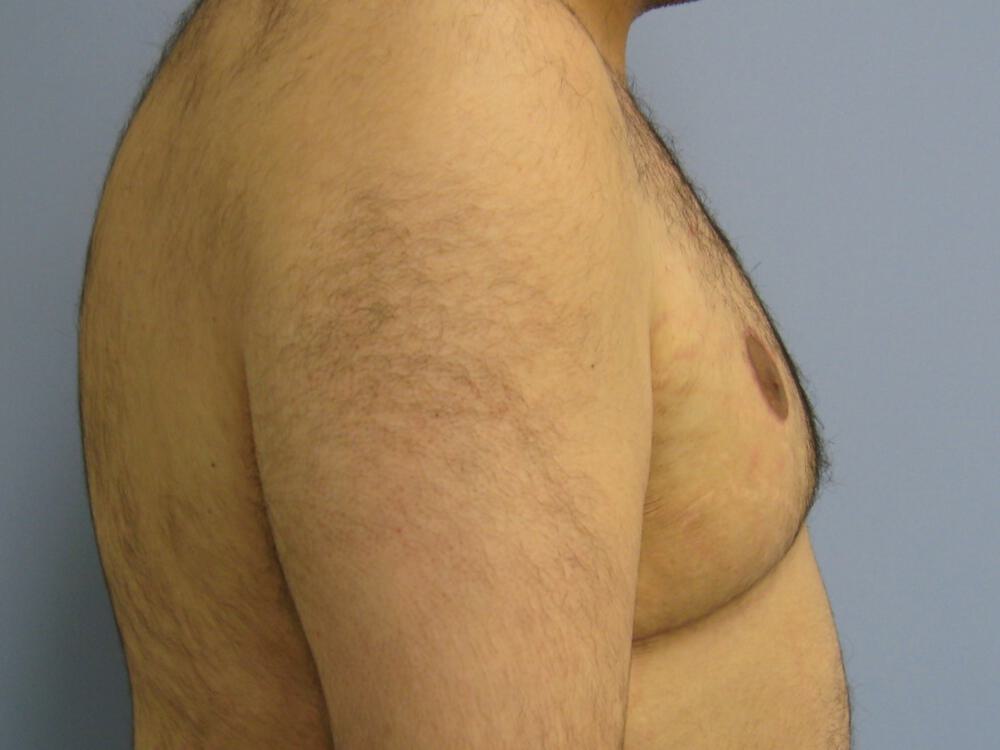 Gynecomastia Before & After Image