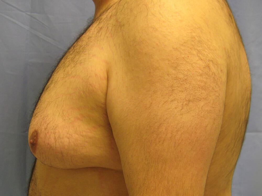 Gynecomastia Surgery Before & After Image