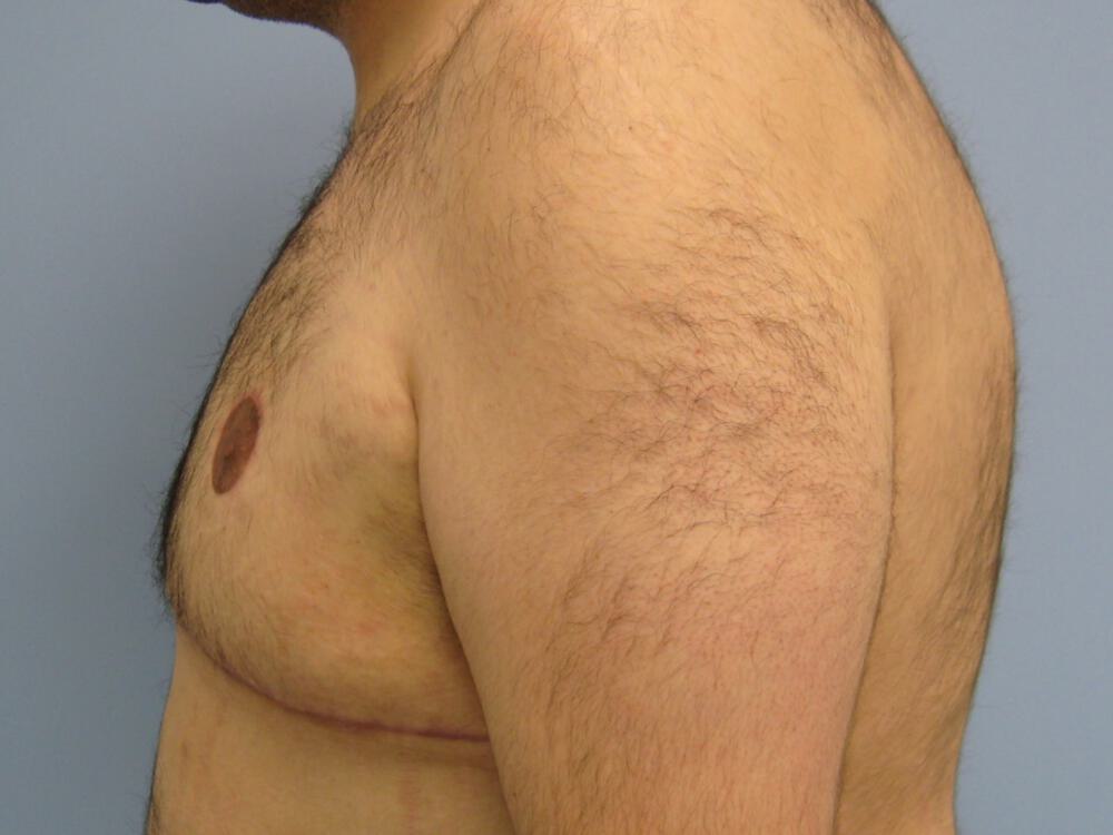 Gynecomastia Surgery Before & After Image