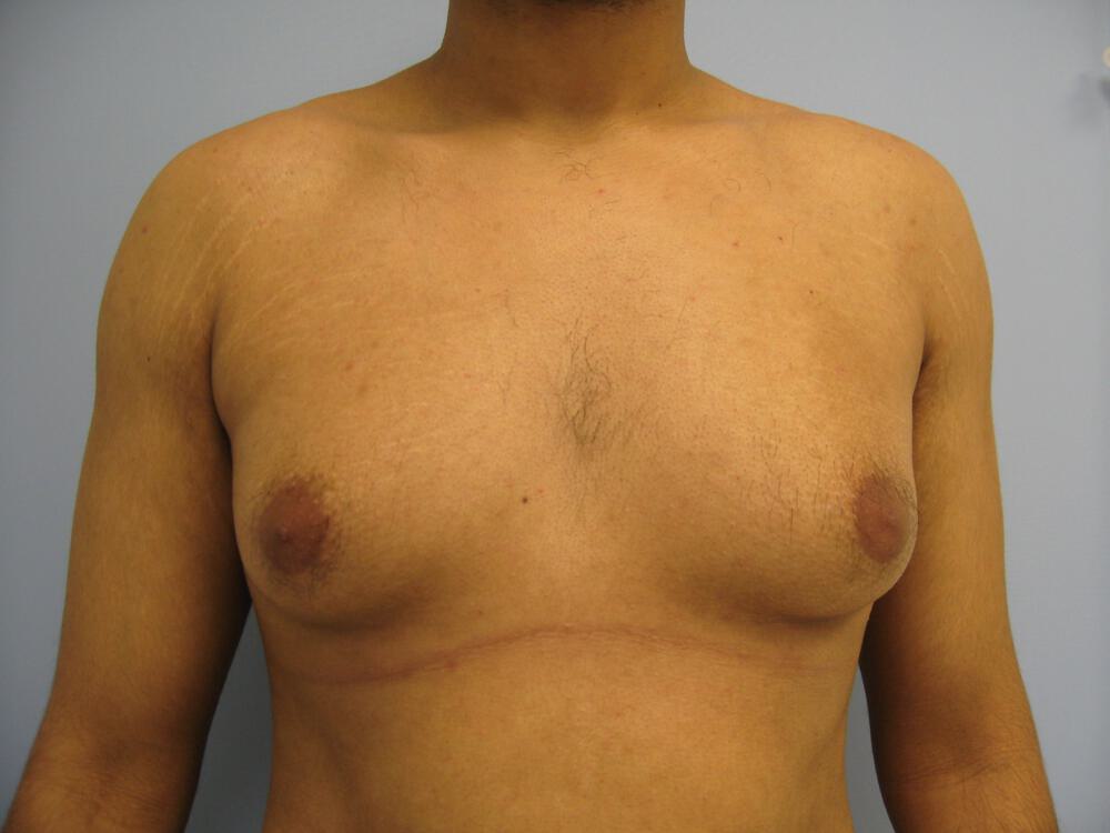 Gynecomastia Before & After Image