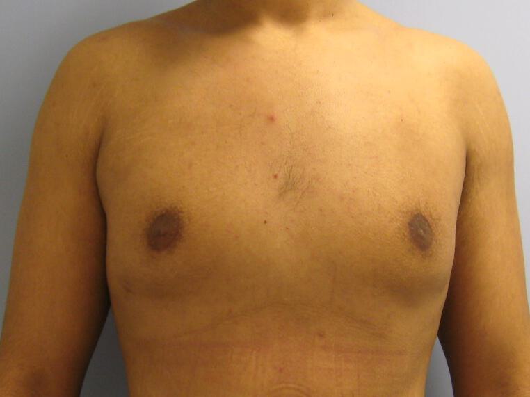 Gynecomastia Before & After Image