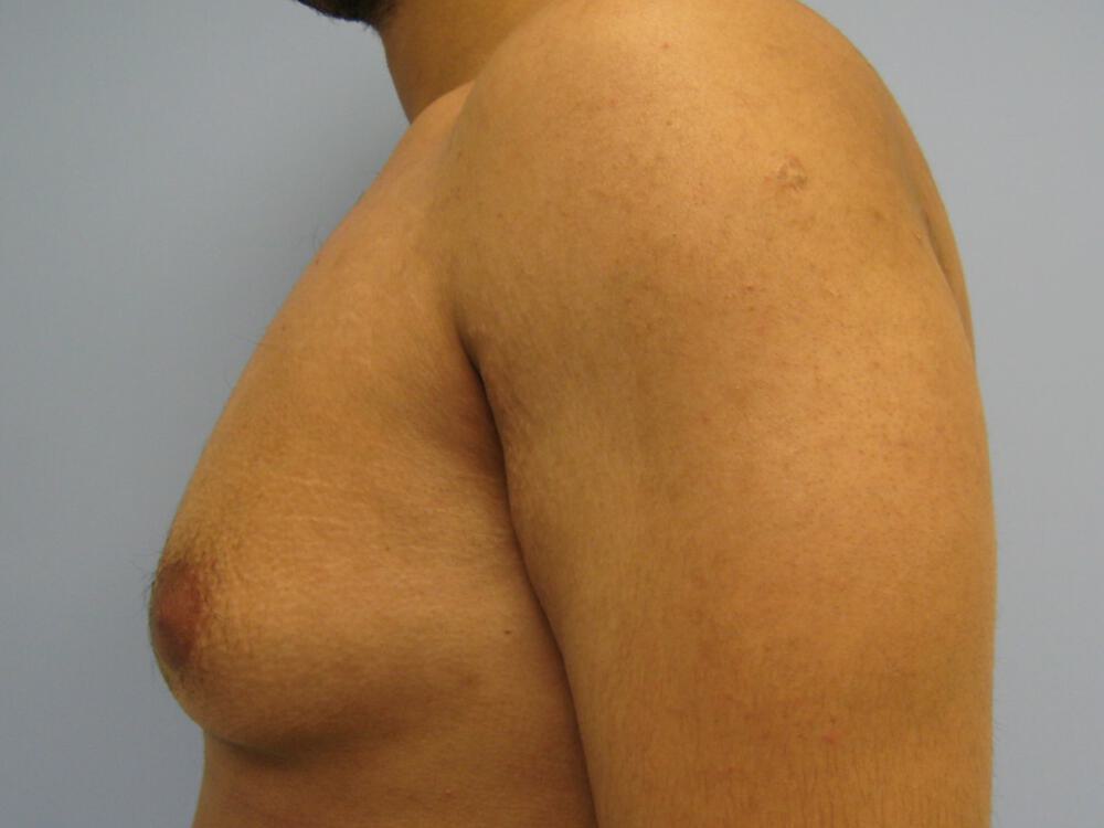 Gynecomastia Before & After Image