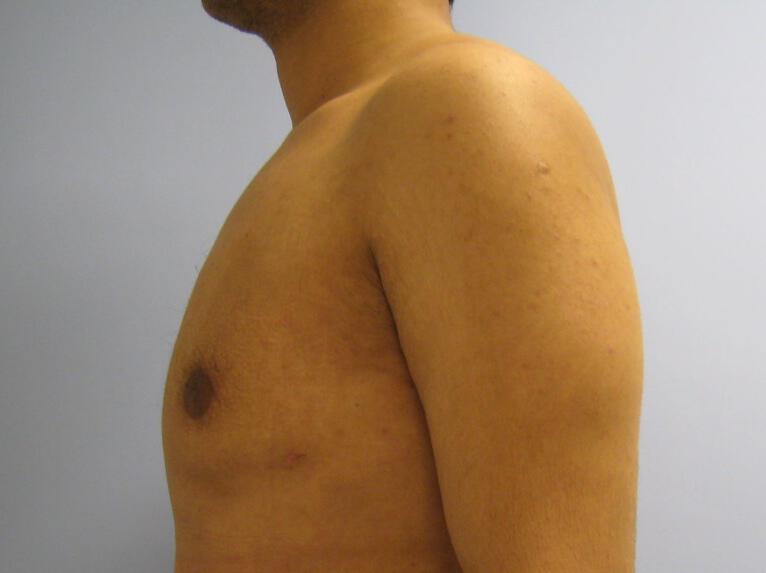 Gynecomastia Before & After Image