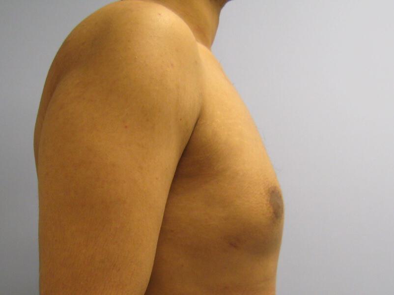 Gynecomastia Surgery Before & After Image