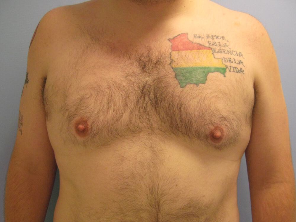 Gynecomastia Before & After Image
