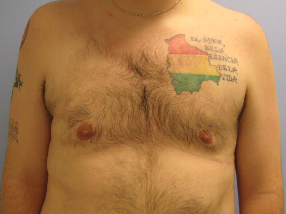 Gynecomastia Before & After Image