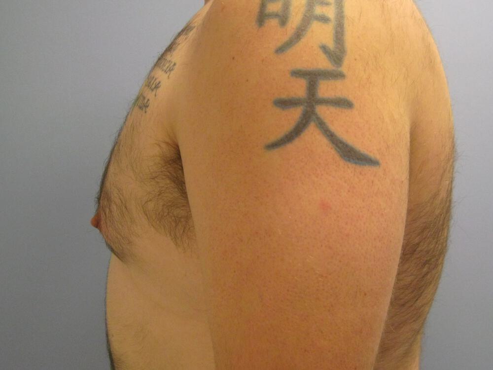 Gynecomastia Before & After Image