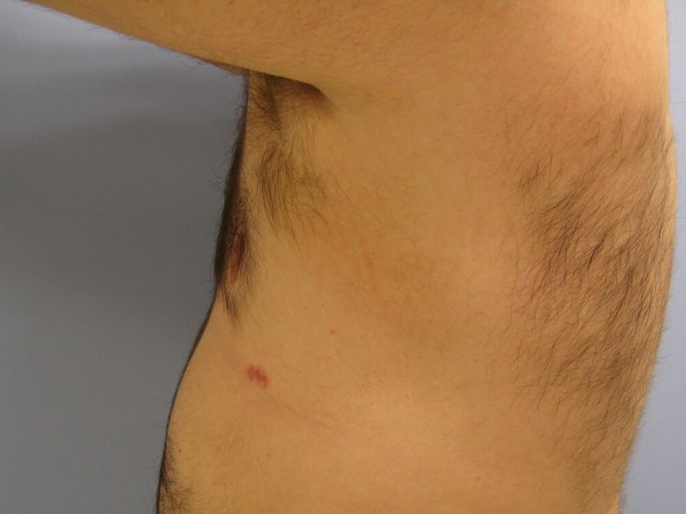 Gynecomastia Before & After Image