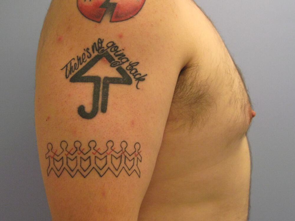 Gynecomastia Surgery Before & After Image