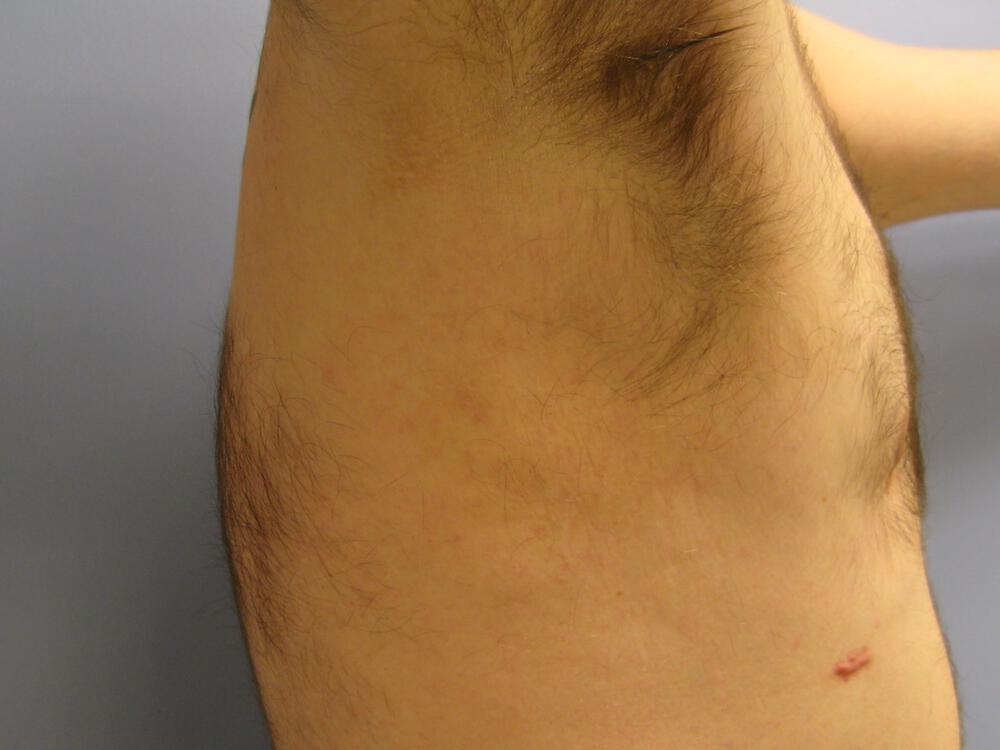 Gynecomastia Surgery Before & After Image
