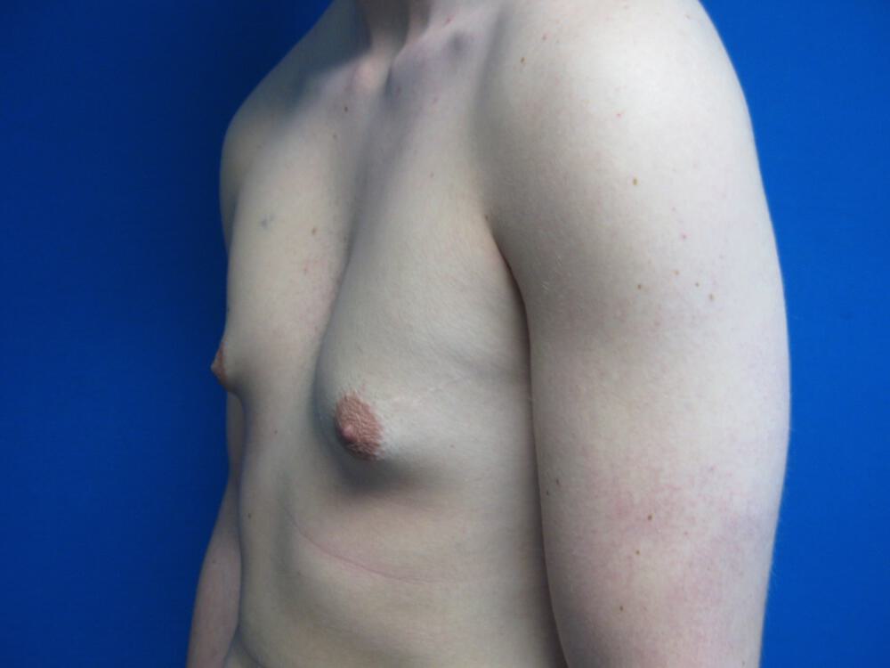 Gynecomastia Before & After Image