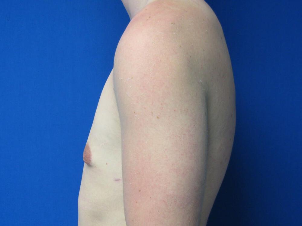 Gynecomastia Before & After Image