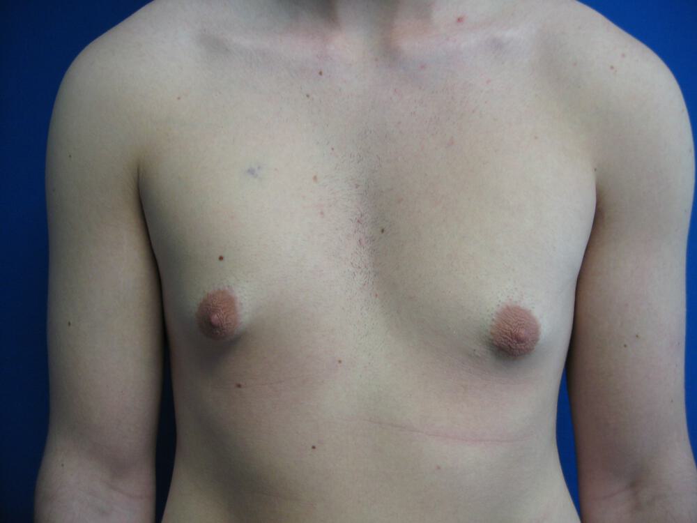 Gynecomastia Before & After Image