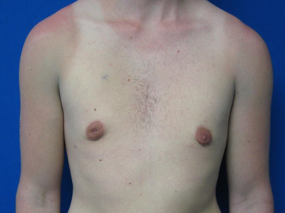 Gynecomastia Before & After Image