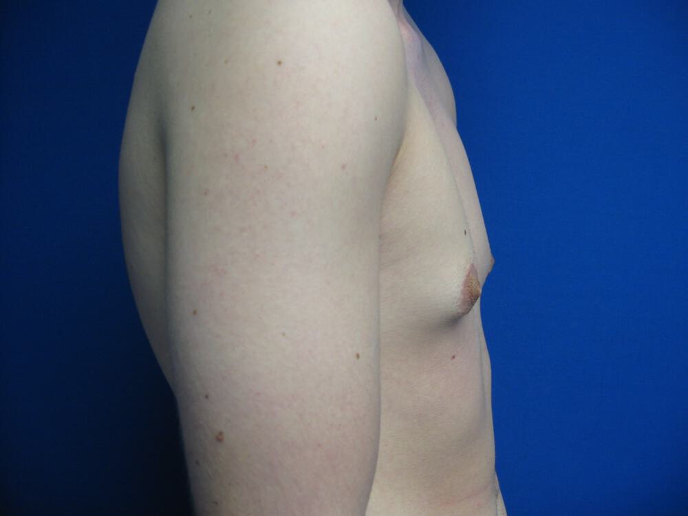 Gynecomastia Surgery Before & After Image