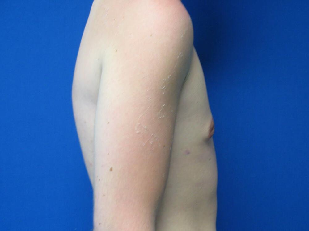Gynecomastia Surgery Before & After Image