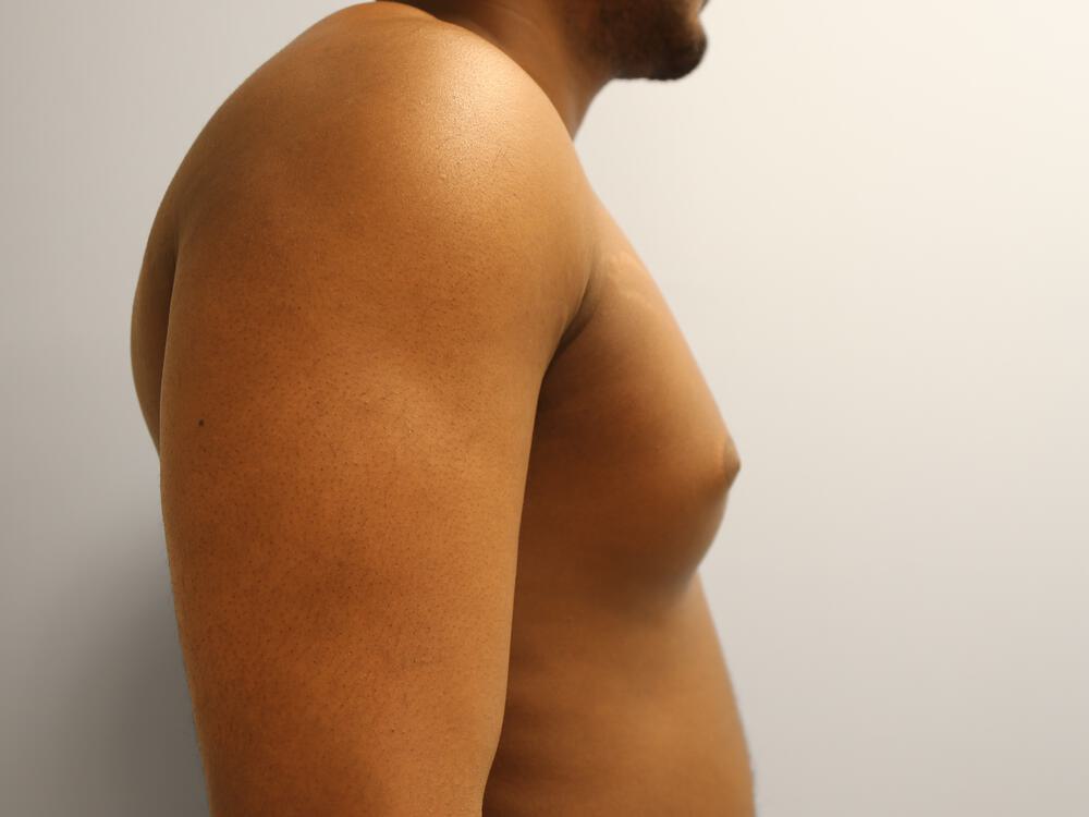 Gynecomastia Before & After Image