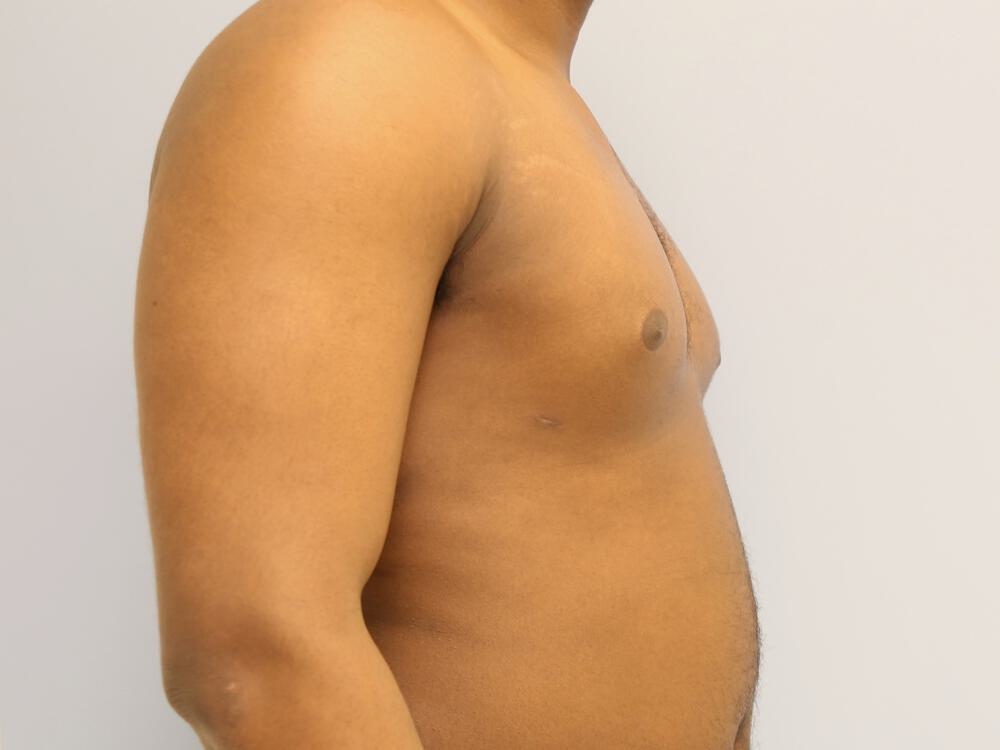 Gynecomastia Before & After Image