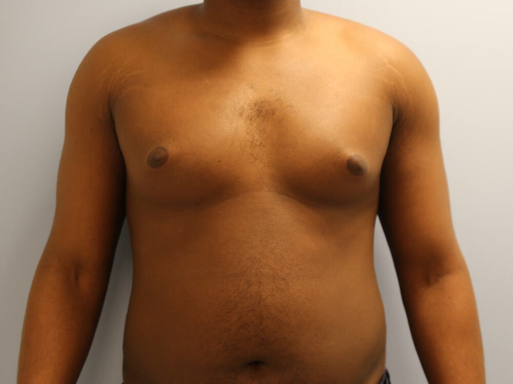 Gynecomastia Before & After Image