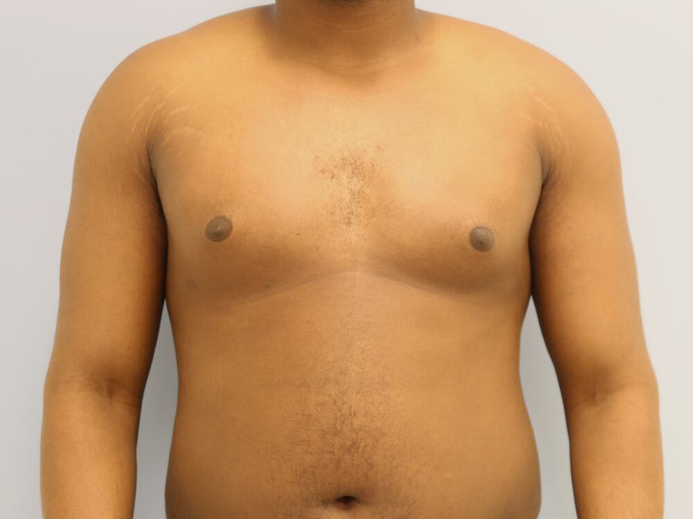 Gynecomastia Before & After Image