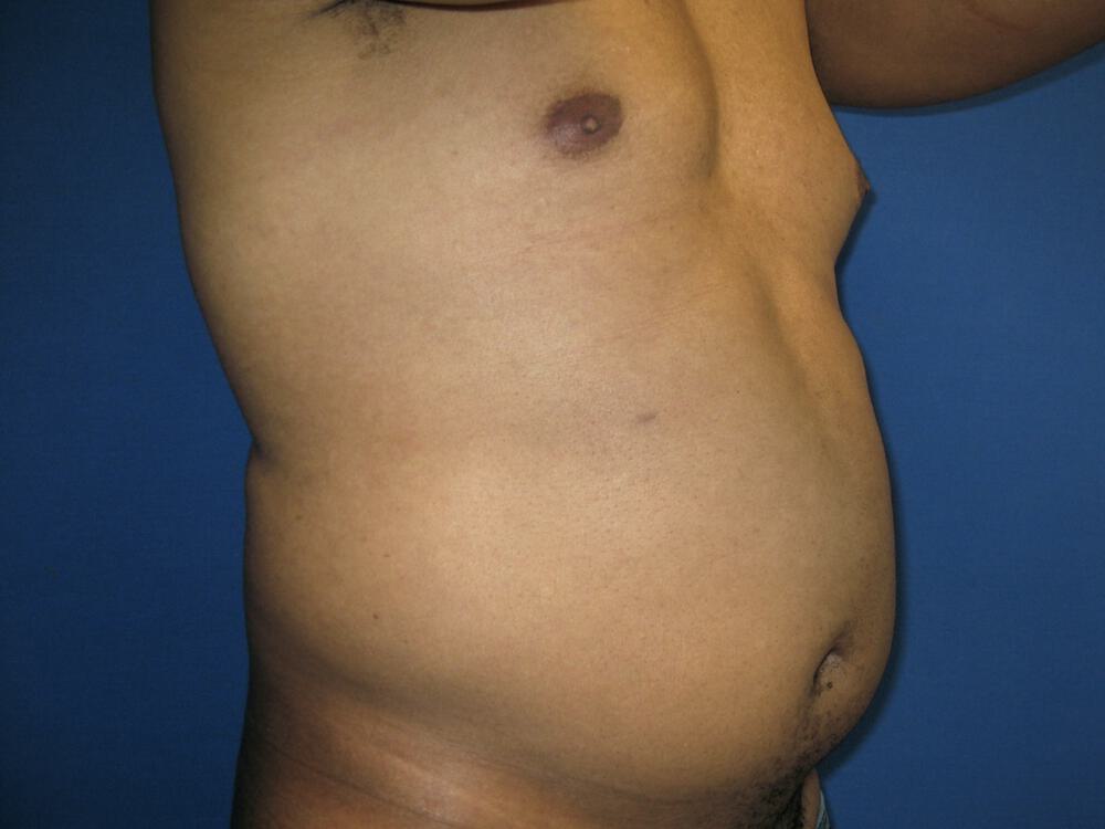 Male Liposuction Before & After Image