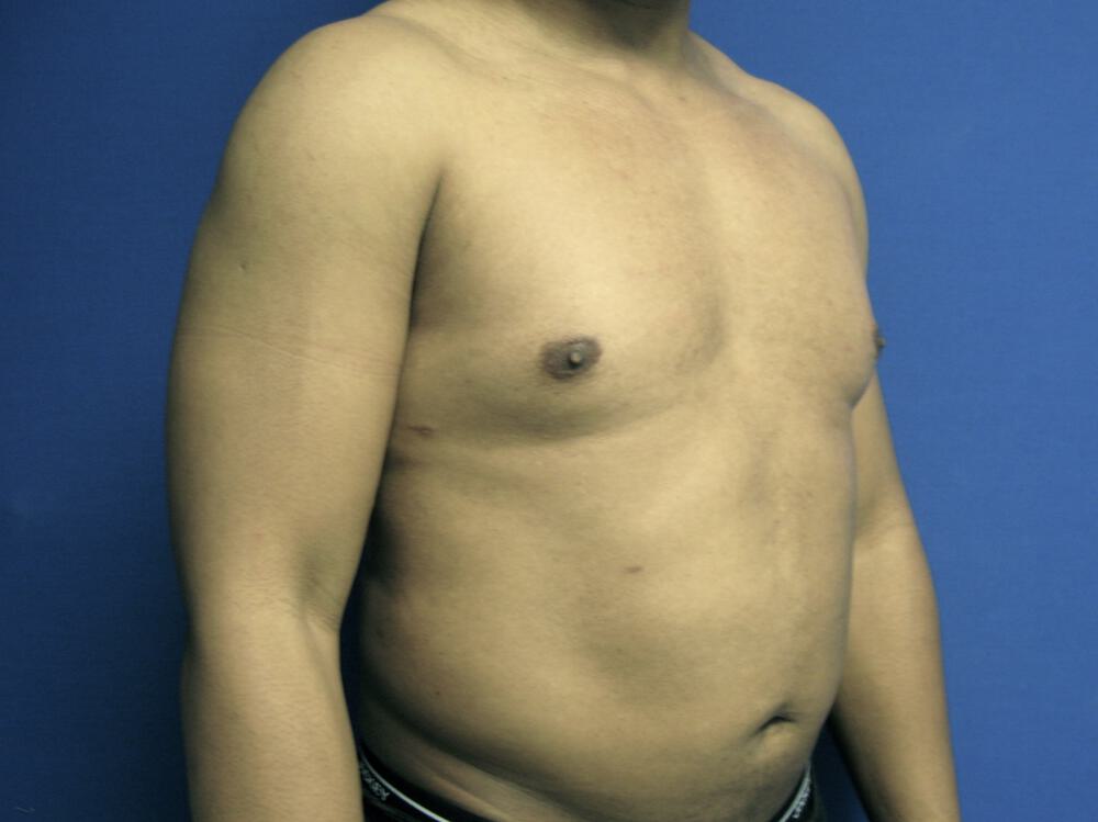 Male Liposuction Before & After Image