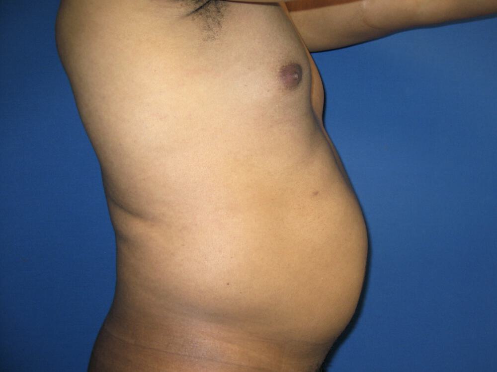 Male Liposuction Before & After Image
