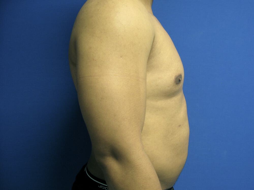 Male Liposuction Before & After Image