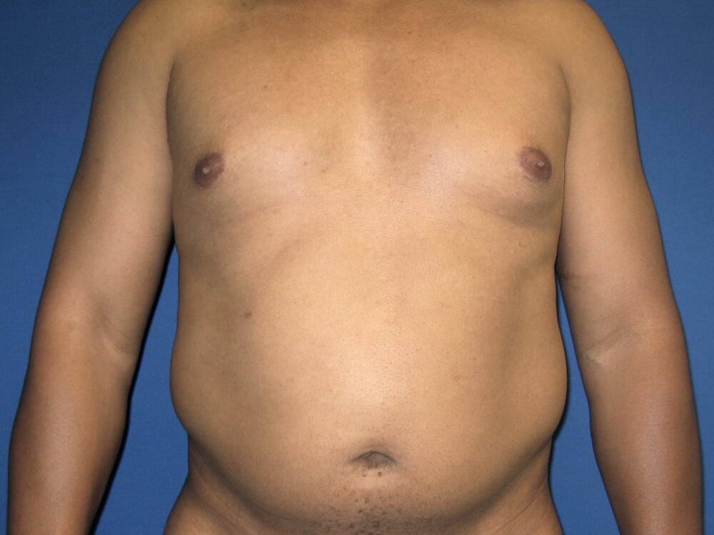 Male Liposuction Before & After Image