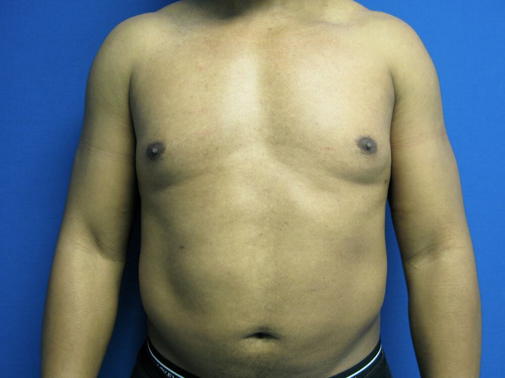 Male Liposuction Before & After Image