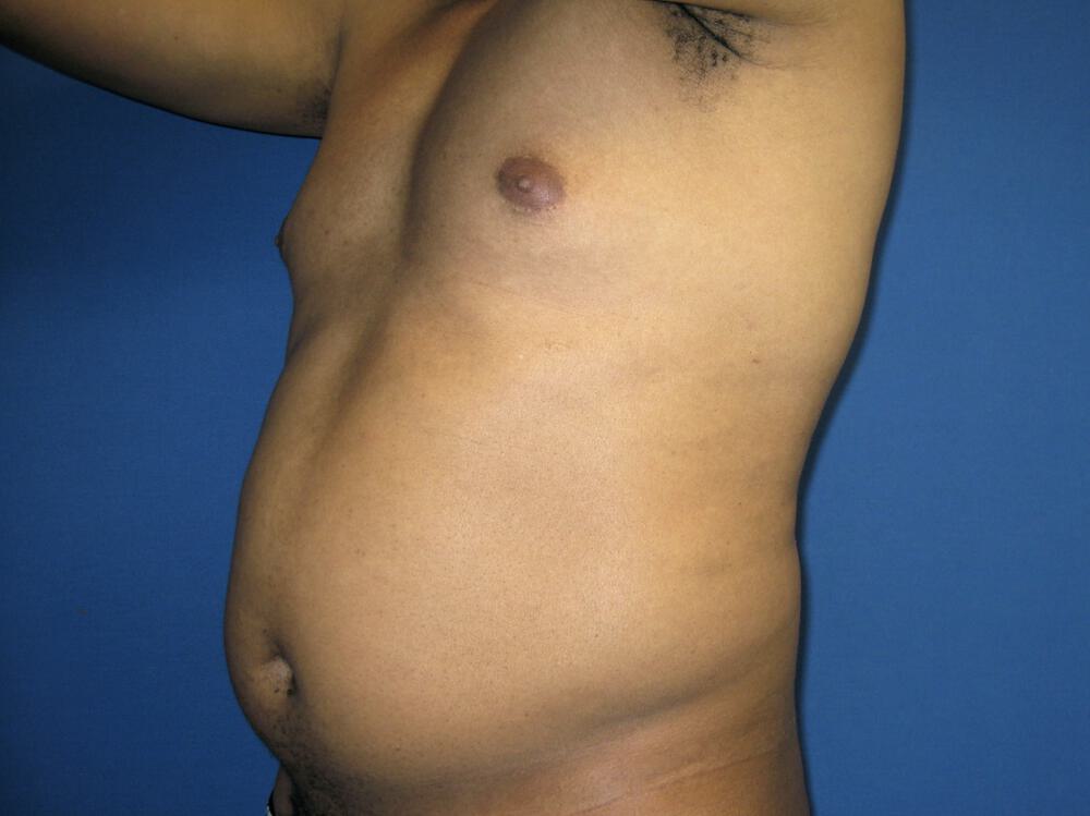 Male Liposuction Before & After Image