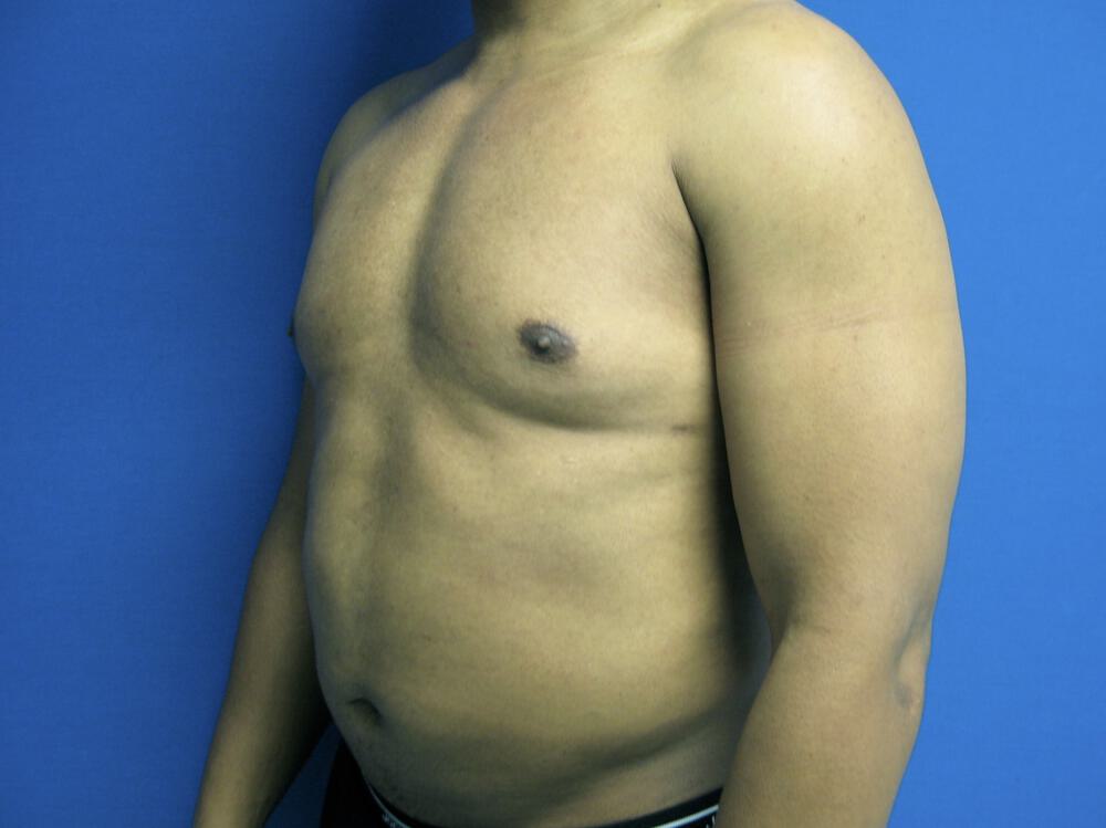 Male Liposuction Before & After Image