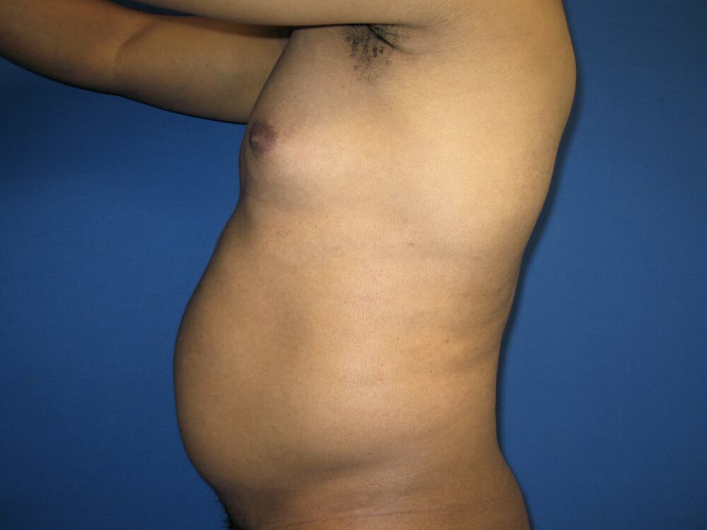 Male Liposuction Before & After Image
