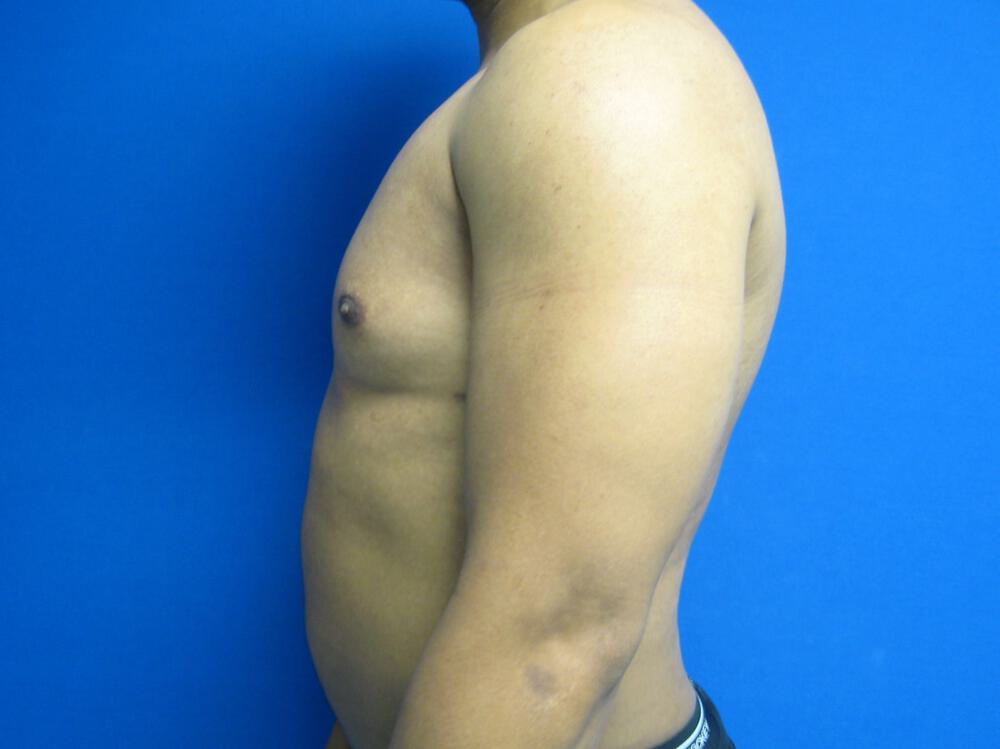 Male Liposuction Before & After Image