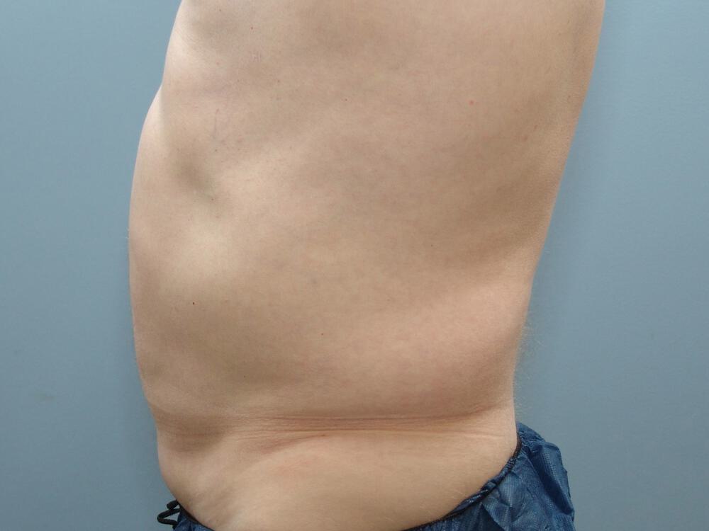 Male Liposuction Before & After Image