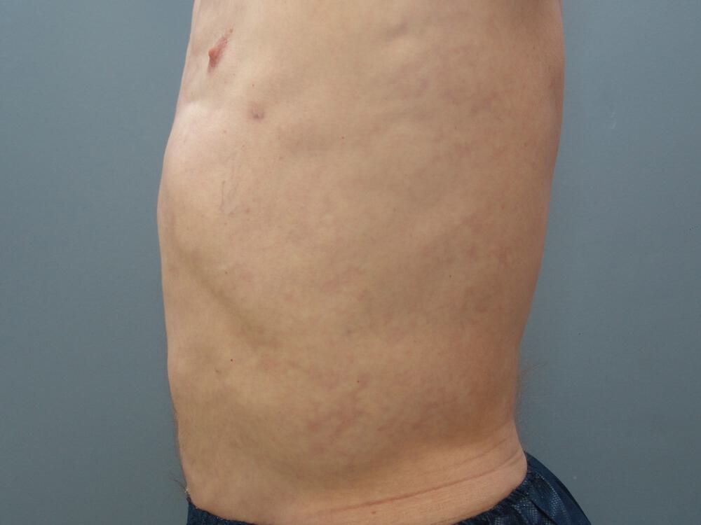 Male Liposuction Before & After Image