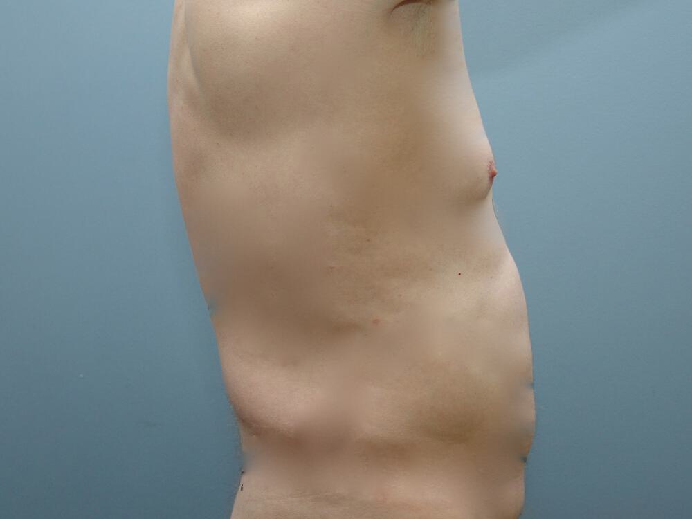 Male Liposuction Before & After Image