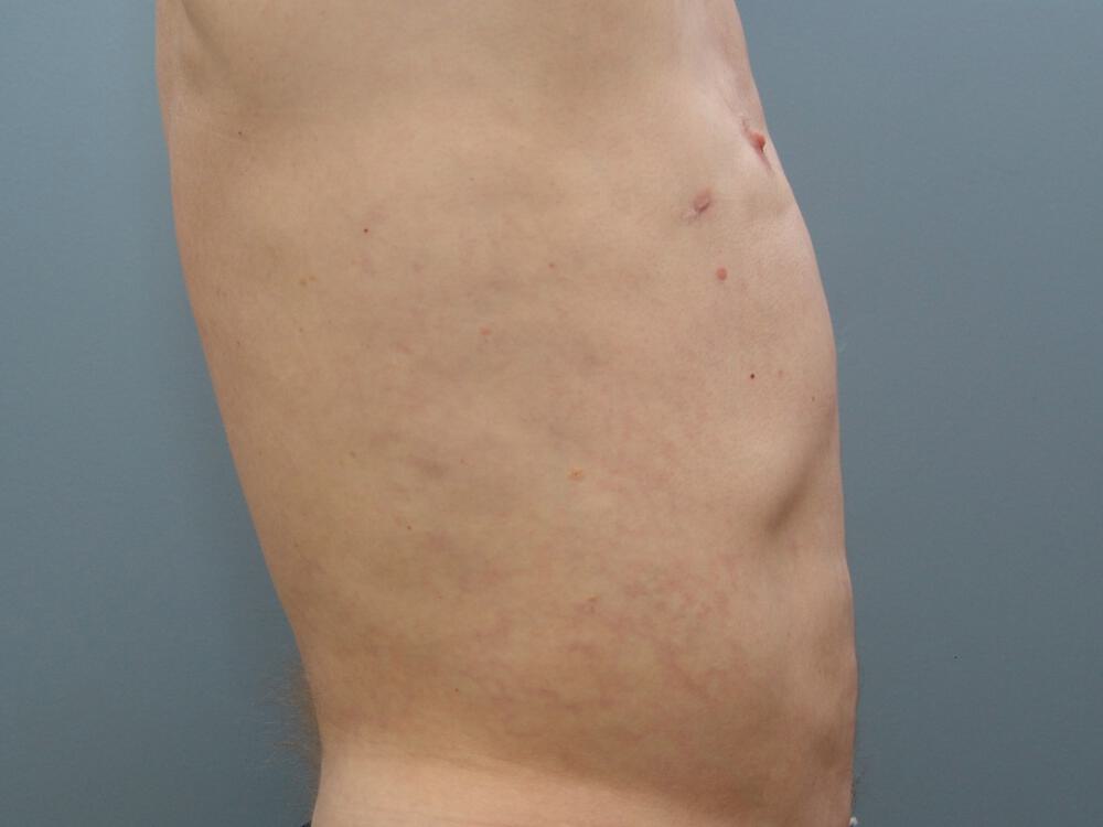 Male Liposuction Before & After Image