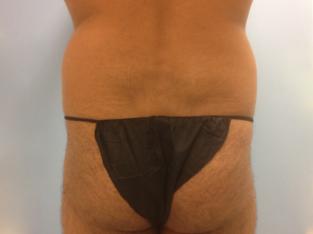 Liposuction Before & After Image
