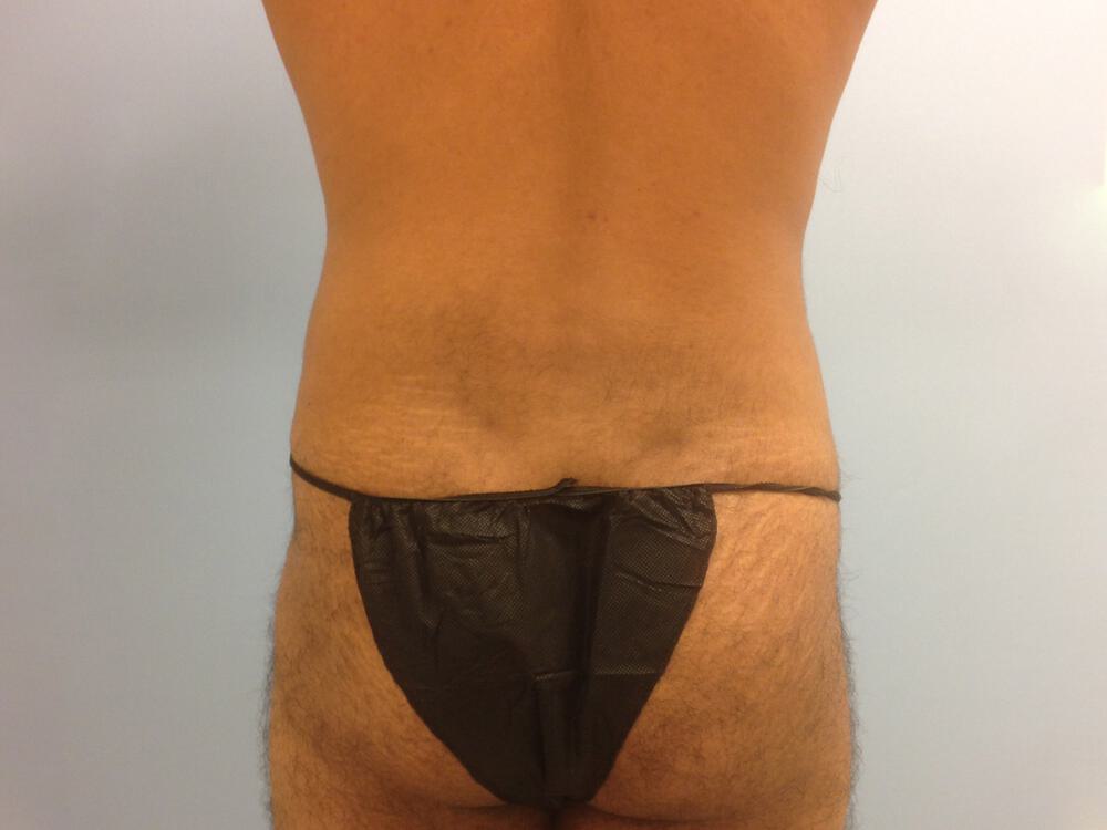 Liposuction Before & After Image