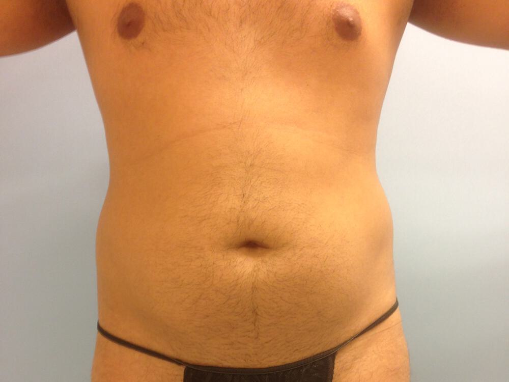 Liposuction Before & After Image