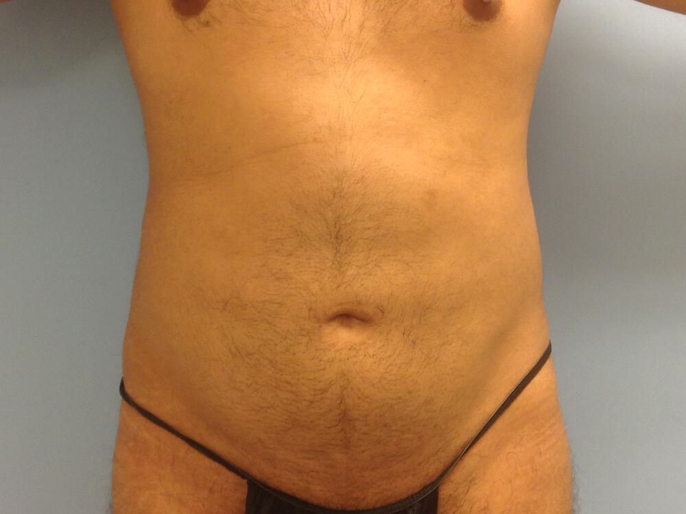 Liposuction Before & After Image