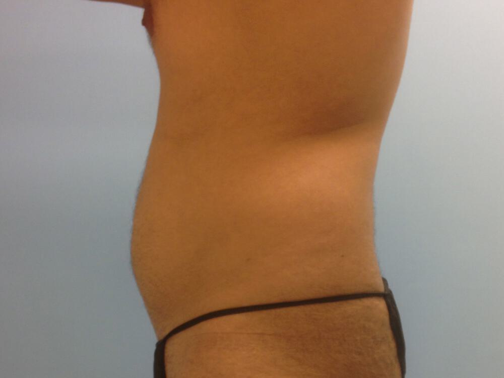 Male Liposuction Before & After Image