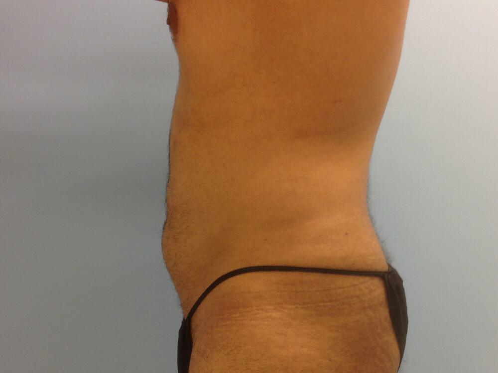 Male Liposuction Before & After Image