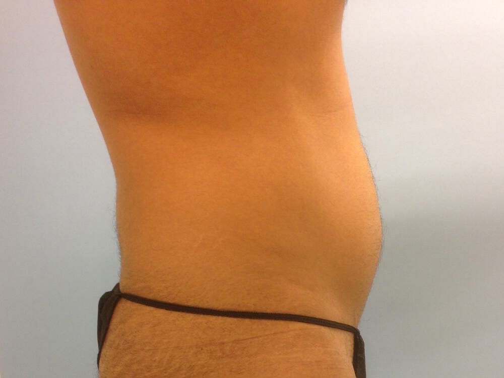 Male Liposuction Before & After Image