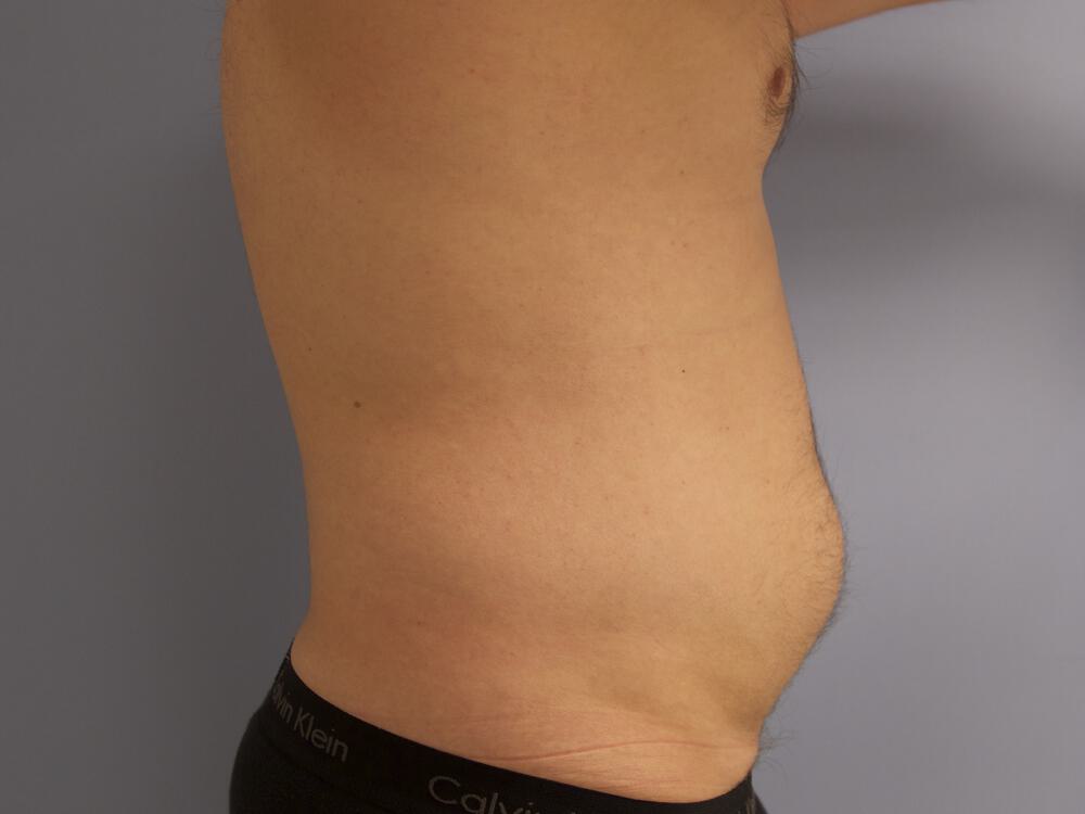 Liposuction Before & After Image